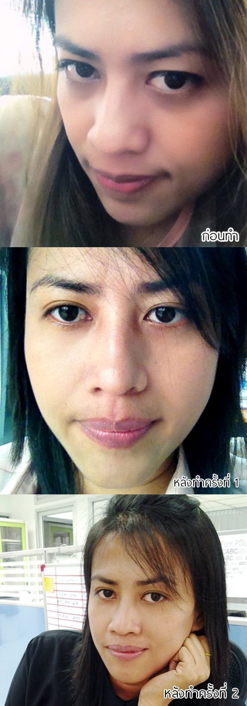 เลเซอร์ปากดำ