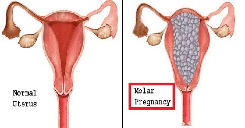 ครรภ์ไข่ปลาอุก (Molar Pregnancy) อาการ, สาเหตุ, การรักษา ฯลฯ