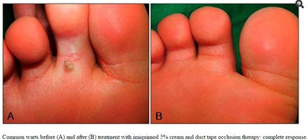 ยาทาหูด