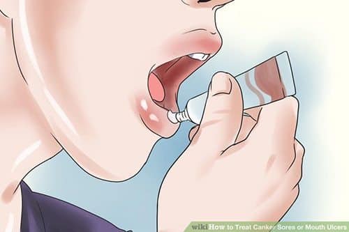 ยาแก้ร้อนใน