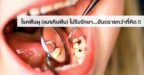 ฟันผุ อาการ สาเหตุ และการรักษาโรคฟันผุ (แมงกินฟัน) 5 วิธี !!