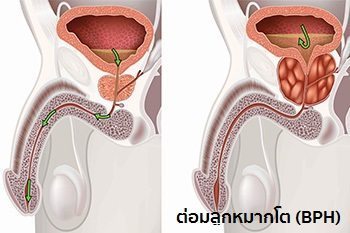 ต่อมลูกหมากโต
