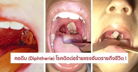 คอตีบ (Diphtheria) อาการ สาเหตุ และการรักษาโรคคอตีบ 9 วิธี !!