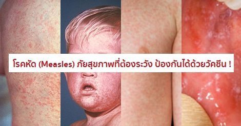 หัด (Measles) อาการ สาเหตุ และการรักษาโรคหัด 8 วิธี !!