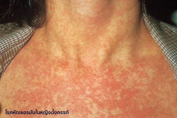 หัดเยอรมันในหญิงตั้งครรภ์