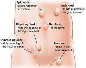 hernia คือ