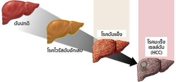 สาเหตุมะเร็งตับ