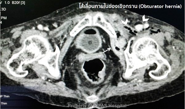 อาการโรคไส้เลื่อน