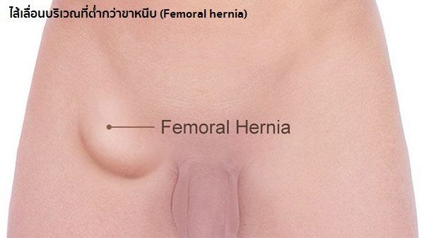 อาการไส้เลื่อน
