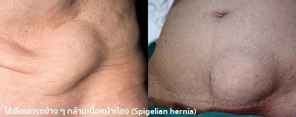 ไส้เลื่อนคือ