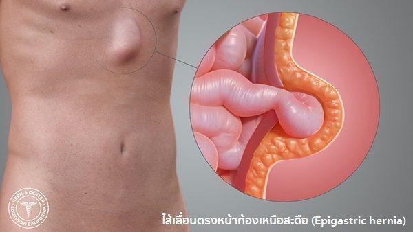 ไส้เลื่อนอาการ