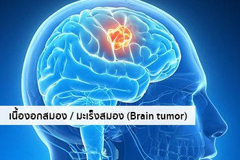 เนื้องอกสมอง