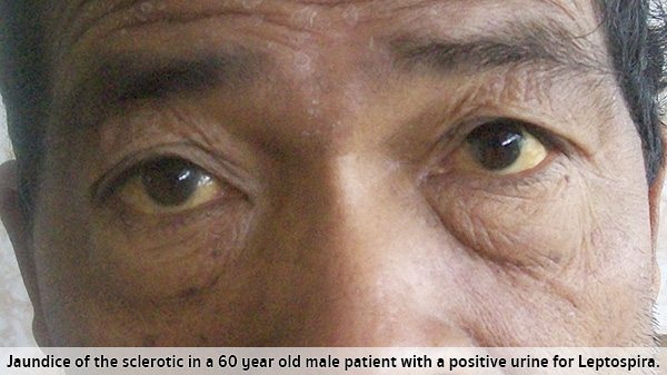 โรคleptospirosis