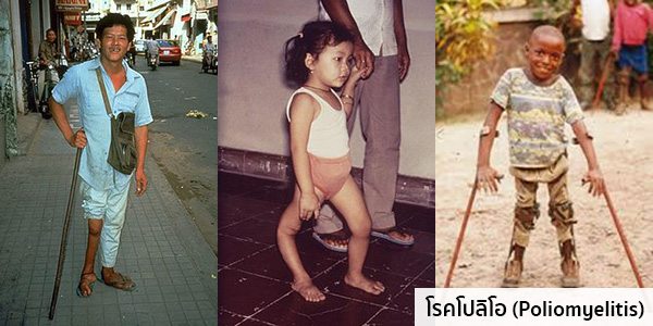รูปโรคโปลิโอ