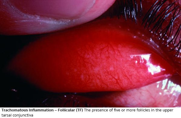 ริดสีดวงตาระดับ 1 (Trachomatous Inflammation Follicular - TF)