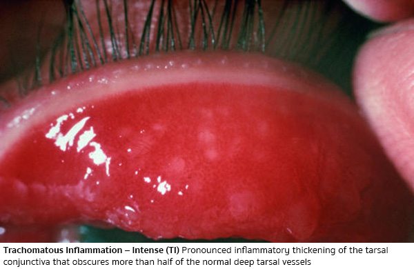ริดสีดวงตาระดับ 2 (Trachomatous Inflammation - TI)