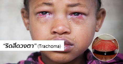 ริดสีดวงตา (Trachoma) อาการ สาเหตุ และการรักษาโรคริดสีดวงตา 5 วิธี !!