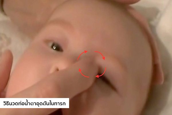 ผลการค้นหารูปภาพสำหรับ ท่อน้ำตาอุดตัน ในเด็กทารก