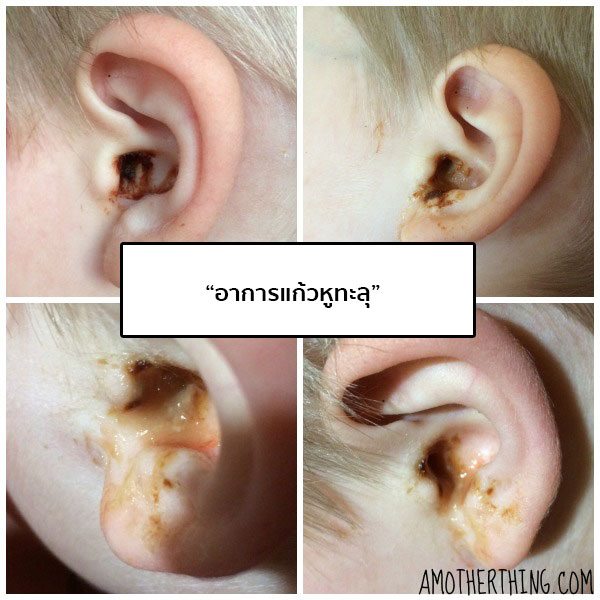 แก้วหูทะลุ (Ruptured Eardrum) อาการ สาเหตุ และการรักษาเยื่อแก้วหูทะลุ 5  วิธี !!