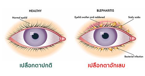 เปลือกตาอักเสบ (Blepharitis) อาการ สาเหตุ การรักษาเปลือกตาอักเสบ 8 วิธี !!