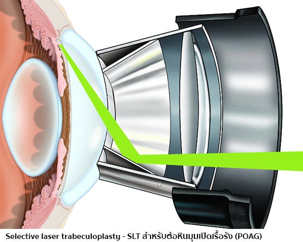 การผ่าตัดต้อหินด้วยเลเซอร์