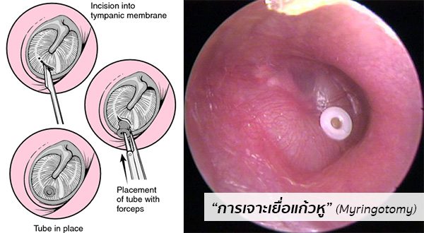 การรักษาหูชั้นกลางอักเสบ
