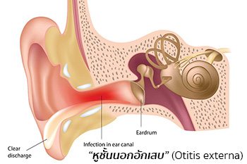 การอักเสบของหูชั้นนอก