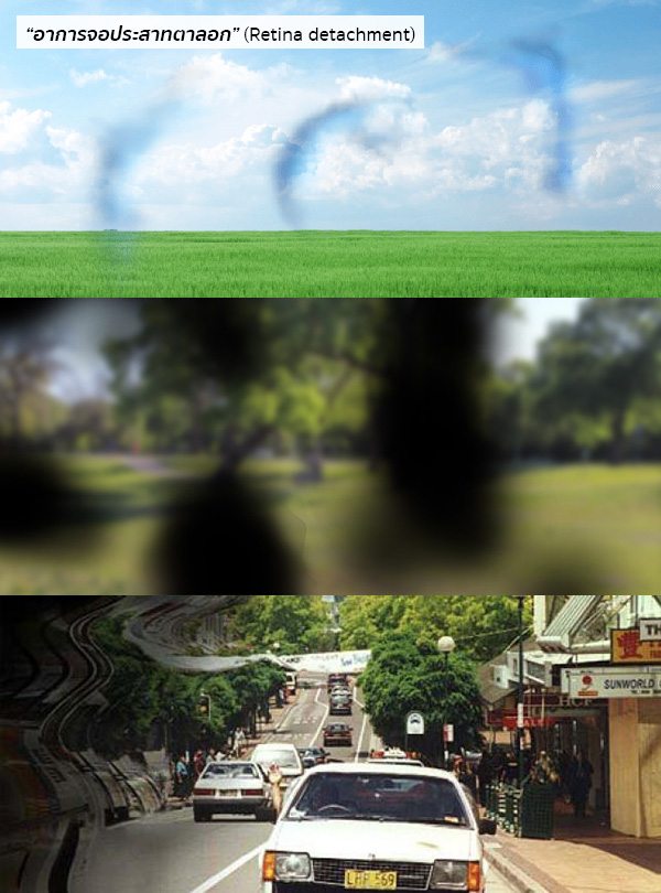 จอประสาทตาลอกอาการ