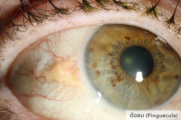 ต้อลม (Pinguecula)
