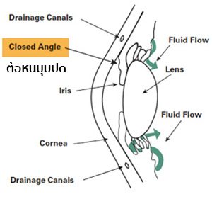ต้อหินมุมปิด