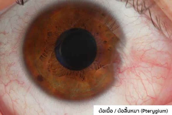 ต้อเนื้ออาการเริ่มต้น