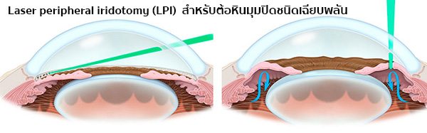 ผ่าตัดต้อหิน