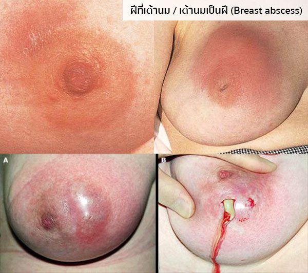 ฝีที่เต้านม