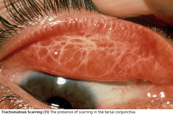 ริดสีดวงตาระดับ 3 (Trachomatous Scarring - TS)