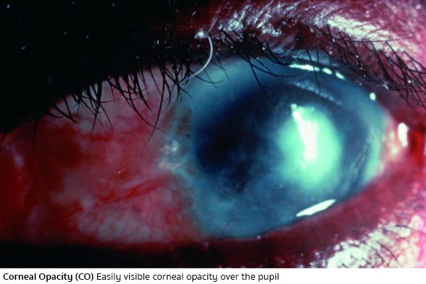 ริดสีดวงตาระดับ 5 (Corneal Opacity - CO)