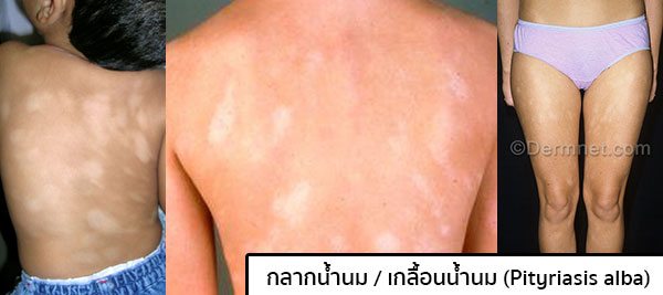 รูปกลากน้ำนม