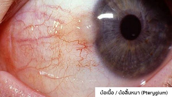 รูปต้อเนื้อ