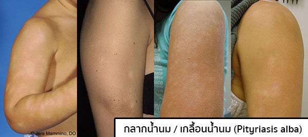 รูปเกลื้อนน้ำนม