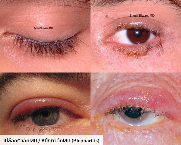 รูปเปลือกตาอักเสบ