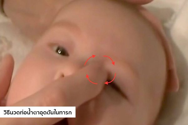 วิธีนวดท่อน้ำตาอุดตันในทารก