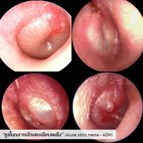 หูชั้นกลางอักเสบเฉียบพลัน