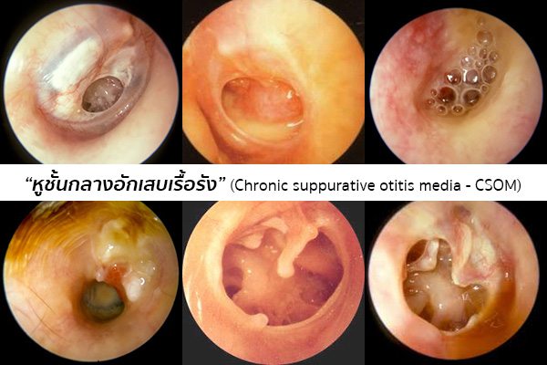 หูชั้นกลางอักเสบเรื้อรัง