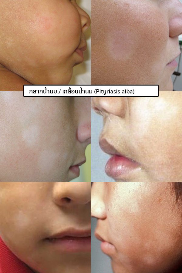 อาการเกลื้อนน้ำนม