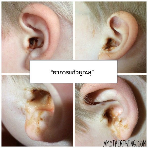 อาการแก้วหูทะลุ