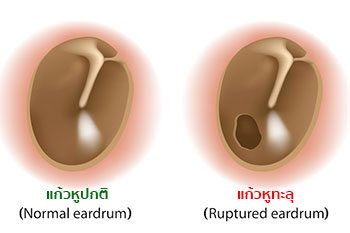 เยื่อแก้วหูทะลุ
