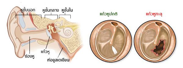 แก้วหูทะลุอันตรายไหม