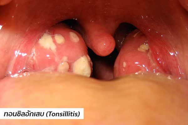ต่อมทอนซิลโต