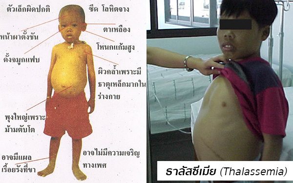 ธาลัสซีเมียอาการ