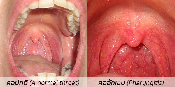 ลําคออักเสบ