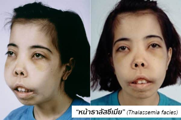 หน้าธาลัสซีเมีย